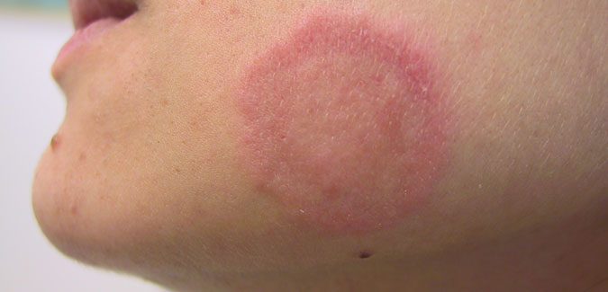 Best Tip To Get Rid Of Ringworm