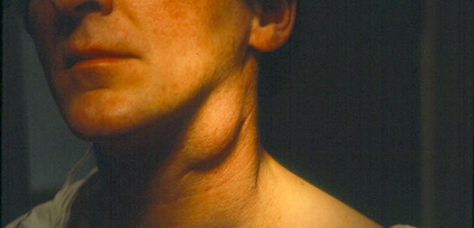 How to Treat Swollen Lymph Nodes?