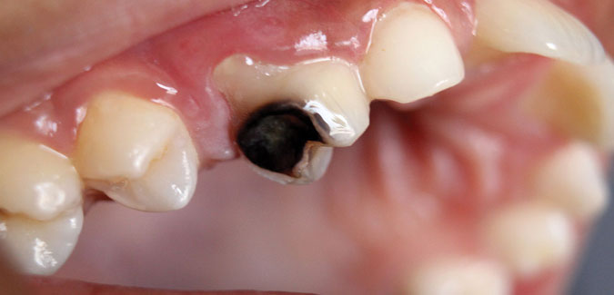 How to Get Rid Of Tooth Decay?