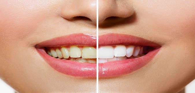 Easy Teeth Whitening Tips at Home in Urdu